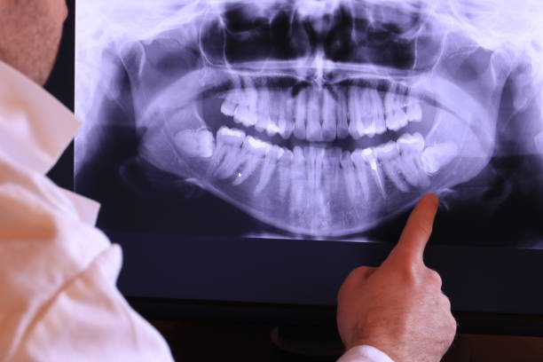 Best Emergency Wisdom Tooth Extraction in Redwood, OR